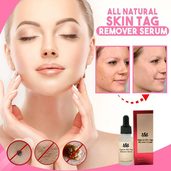 Natural Skin Tag Remover™  |Biologisch serum voor het verwijderen van huidvlekjes!