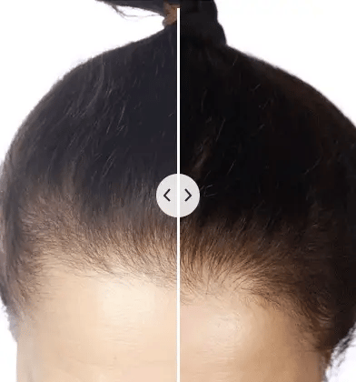 Hair Revive Pro™ -De ultieme oplossing voor haarherstel